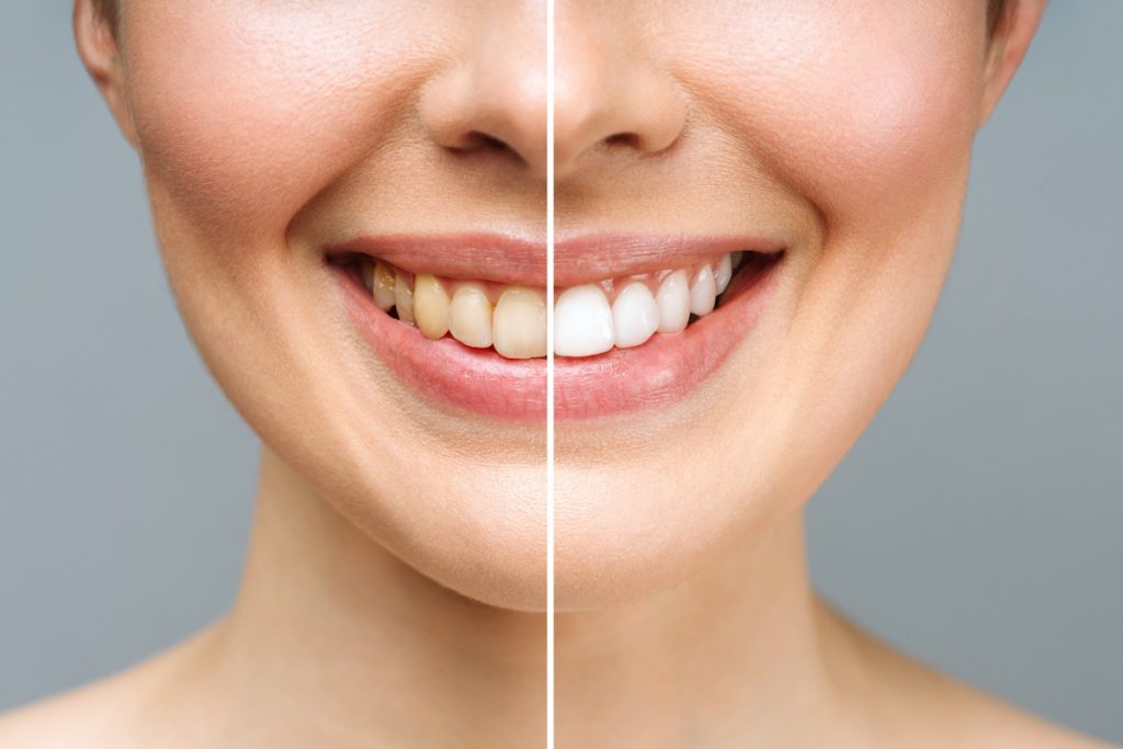 6 teeth whitening tricks that actually work