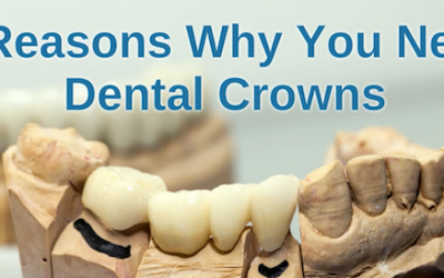 5 Reasons Why You Need Dental Crowns