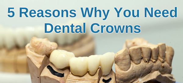 5 Reasons Why You Need Dental Crowns