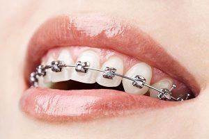 Conventional Braces | Dentist Cardiff