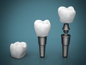 Dental Implants | Dentist Cardiff