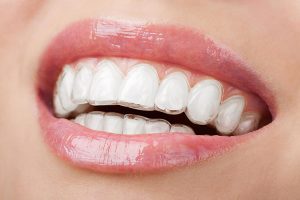 Invisalign | Dentist Cardiff