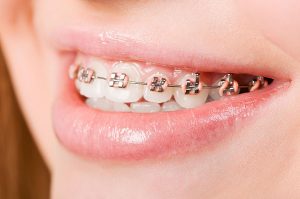 Orthodontics | Dentist Cardiff