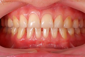 Receding Gums | Dentist Cardiff