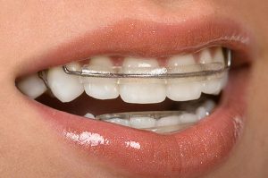 Straightening Teeth Without Braces Cardiff Cardiff Dental