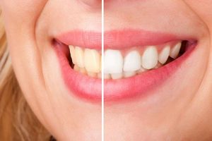 Teeth Whitening | Dentist Cardiff