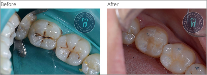 White Fillings Case 1 | Dentist Cardiff