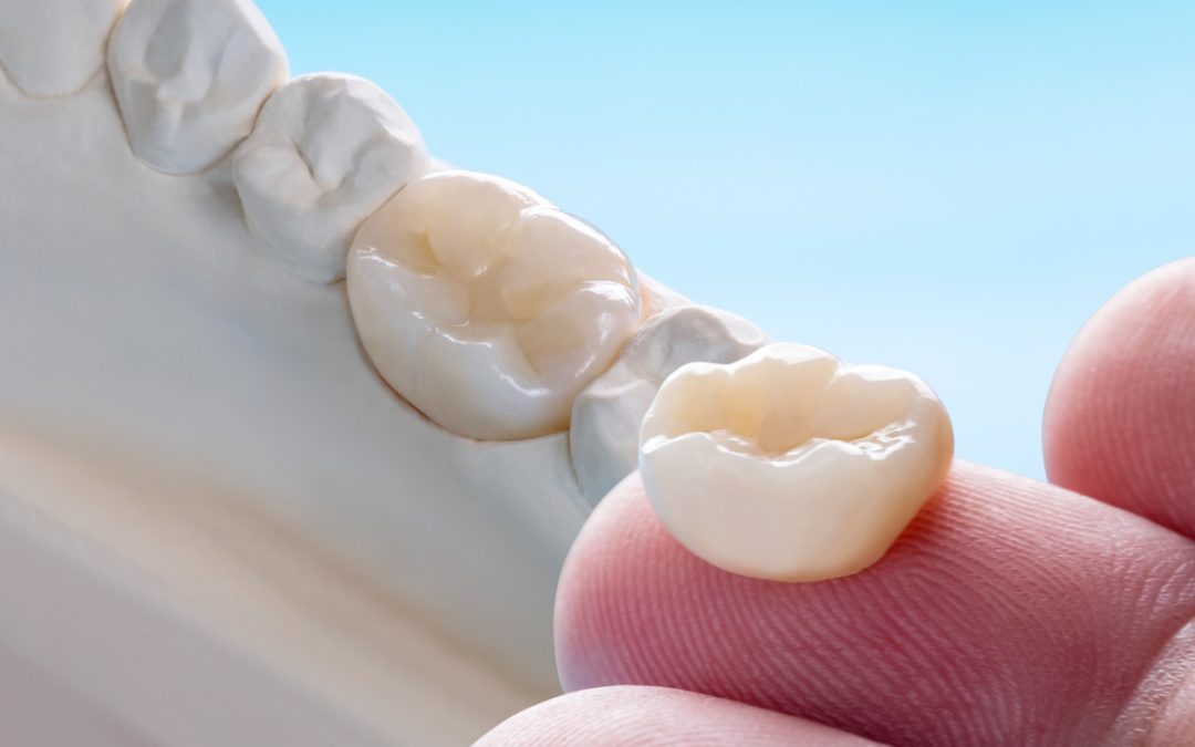 Dental Crowns: What You Should Know
