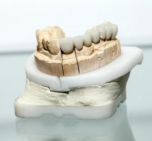 Are Dental Crowns Permanent?