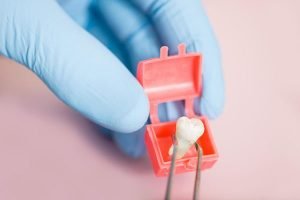 Wisdom Tooth Removal | Dentist Cardiff