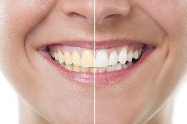How To Whiten Yellow Teeth in One Day