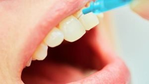 Eliminating Plaque and Tartar Buildup | Dentist Cardiff