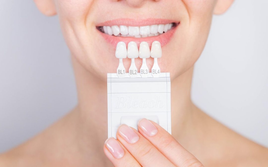 Porcelain Veneers in Cardiff – Should You Shop Around?