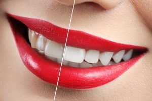 How to Whiten Teeth at Home and in the Dental Office Cardiff