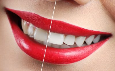 How to Whiten Teeth, at Home and in the Dental Office