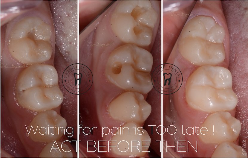 white fillings case 4 cardiff