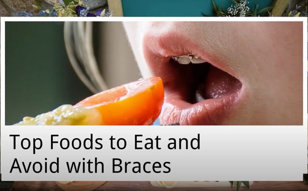 Top Foods to Eat and Avoid with Braces from Cardiff Dental