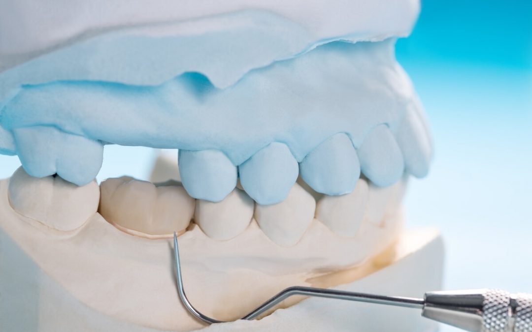 How Long Will Dental Crowns Last? Answers from Cardiff Dental