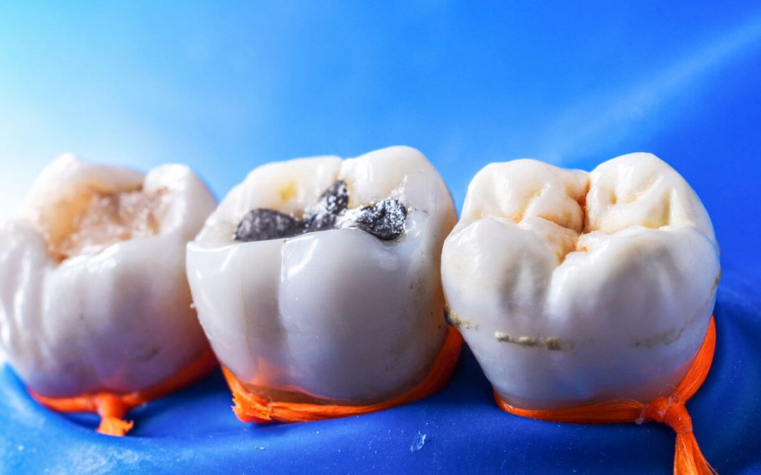 How to Choose the Right Type of Dental Fillings in Cardiff