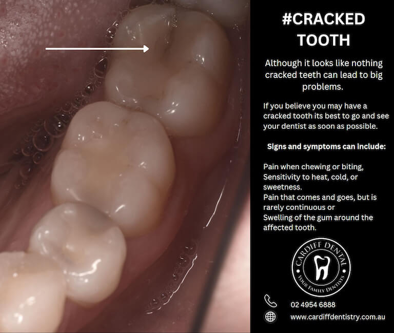 cracdked tooth emergency dentist cardiff