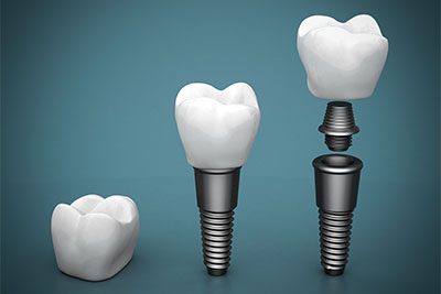 dental implants blurb dentist cardiff