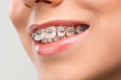 orthodontics blurb dentist cardiff