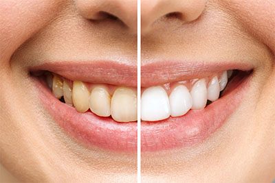 teeth whitening blurb dentist cardiff
