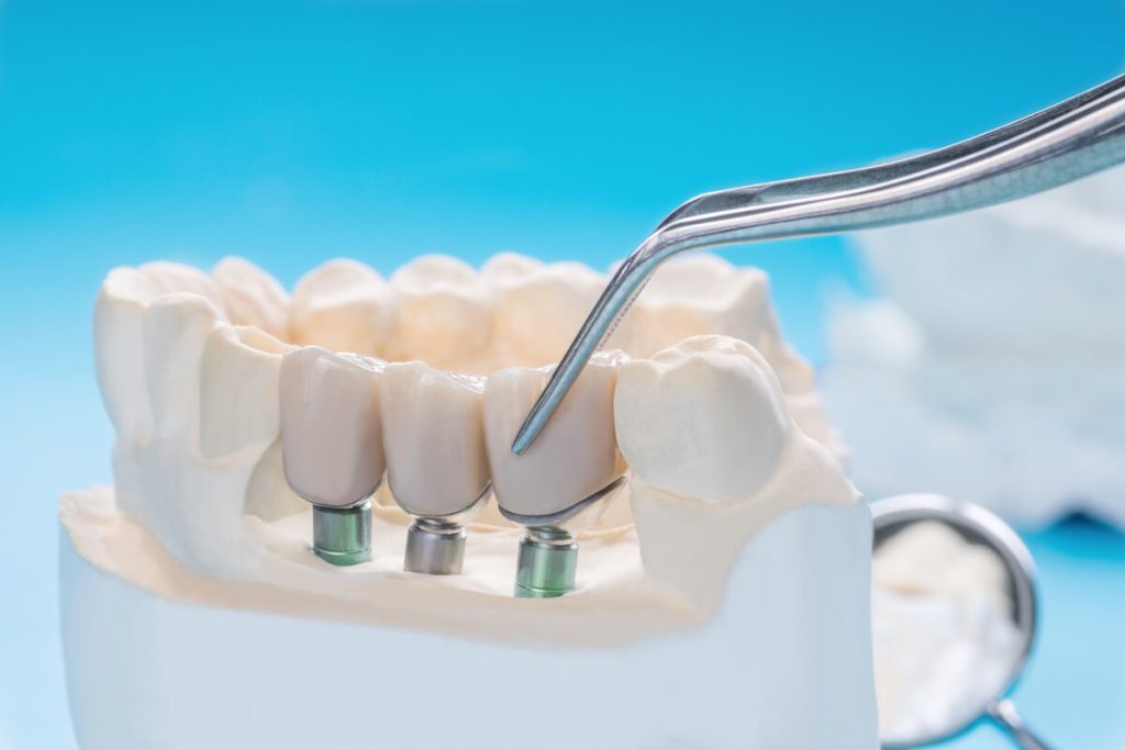 are dental crowns permanent