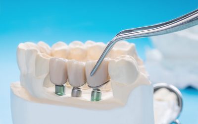 Are Dental Crowns Permanent?