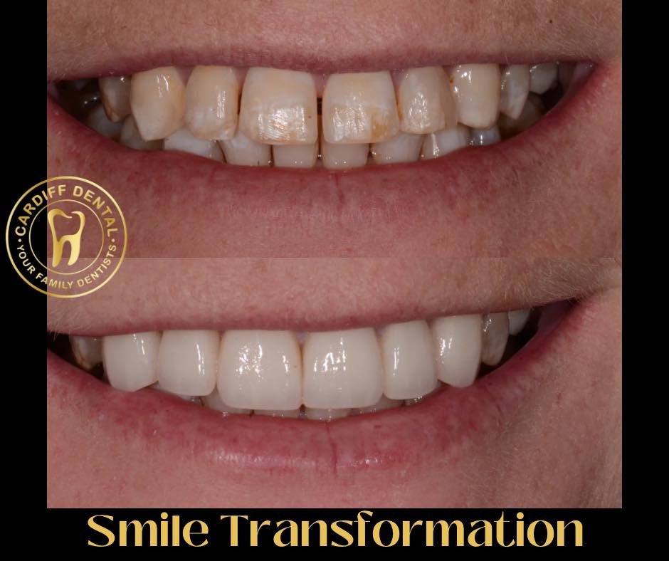 smile transformation before and after dentist cardiff