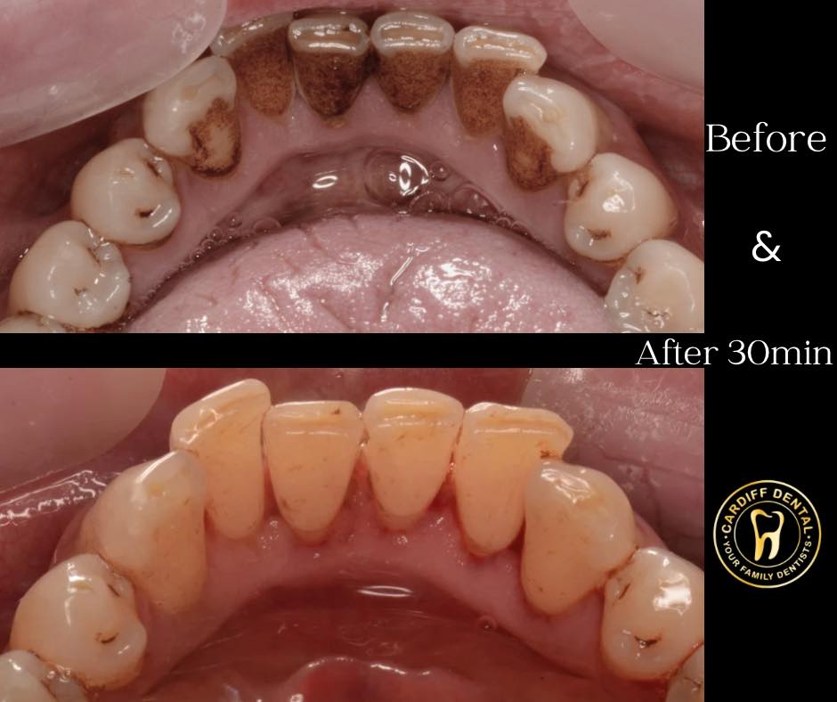 stain removal treatments before and after dentist cardiff