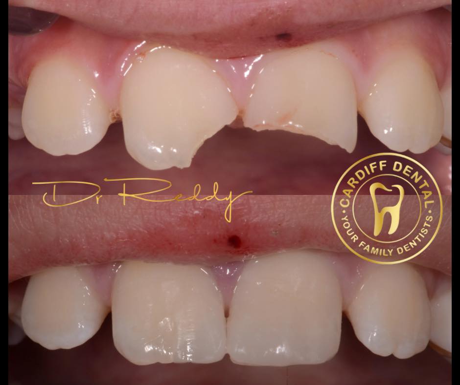 teeth restoration before and after dentist cardiff