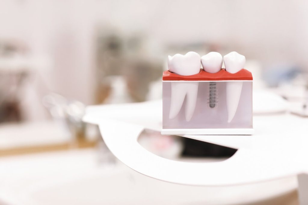 understanding the risks of dental implants before surgery