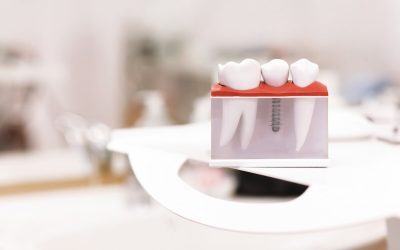 Understanding the Risks of Dental Implants Before Surgery