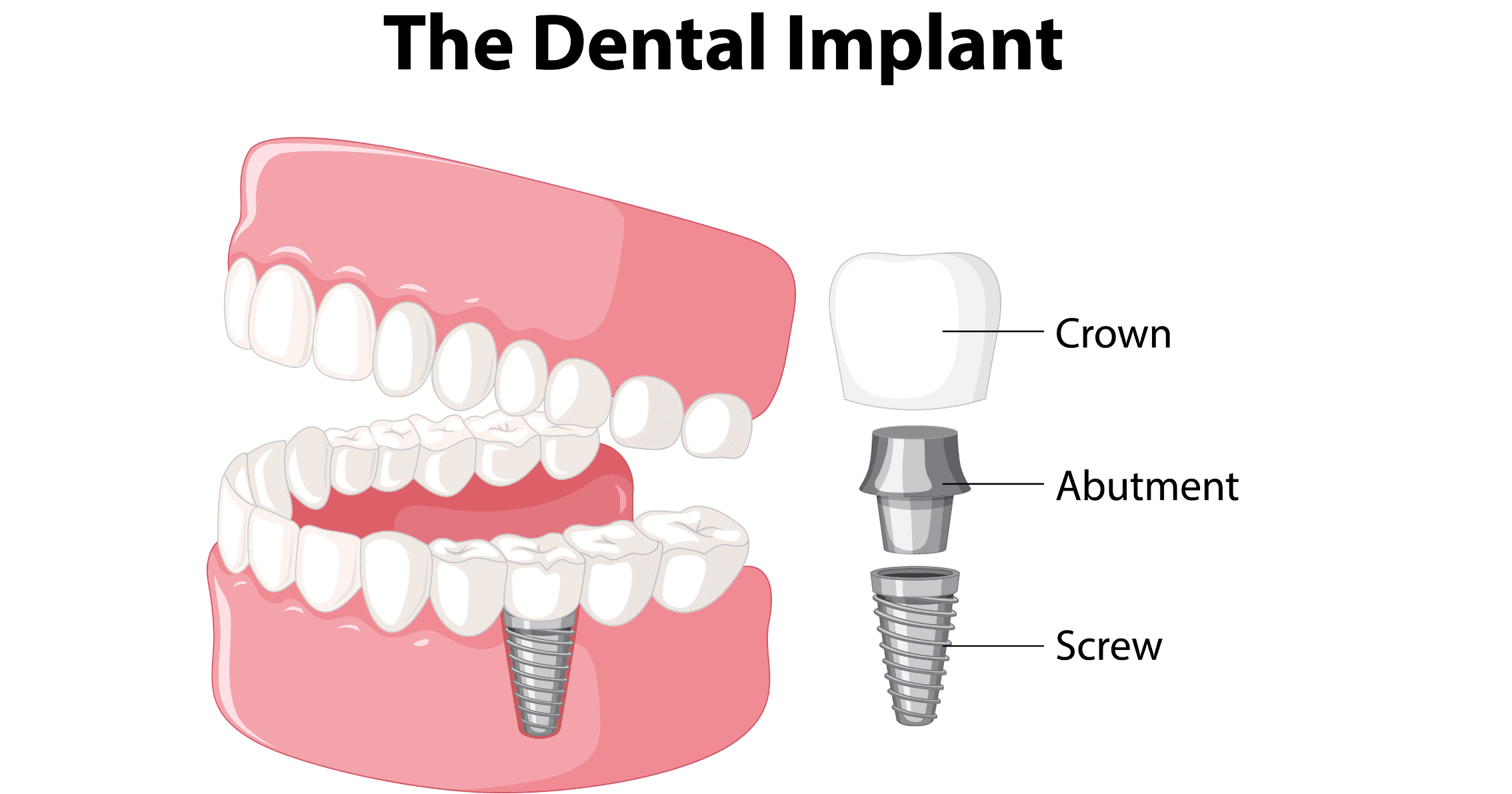 Diagram showing dental implant titanium post, abutment and crown