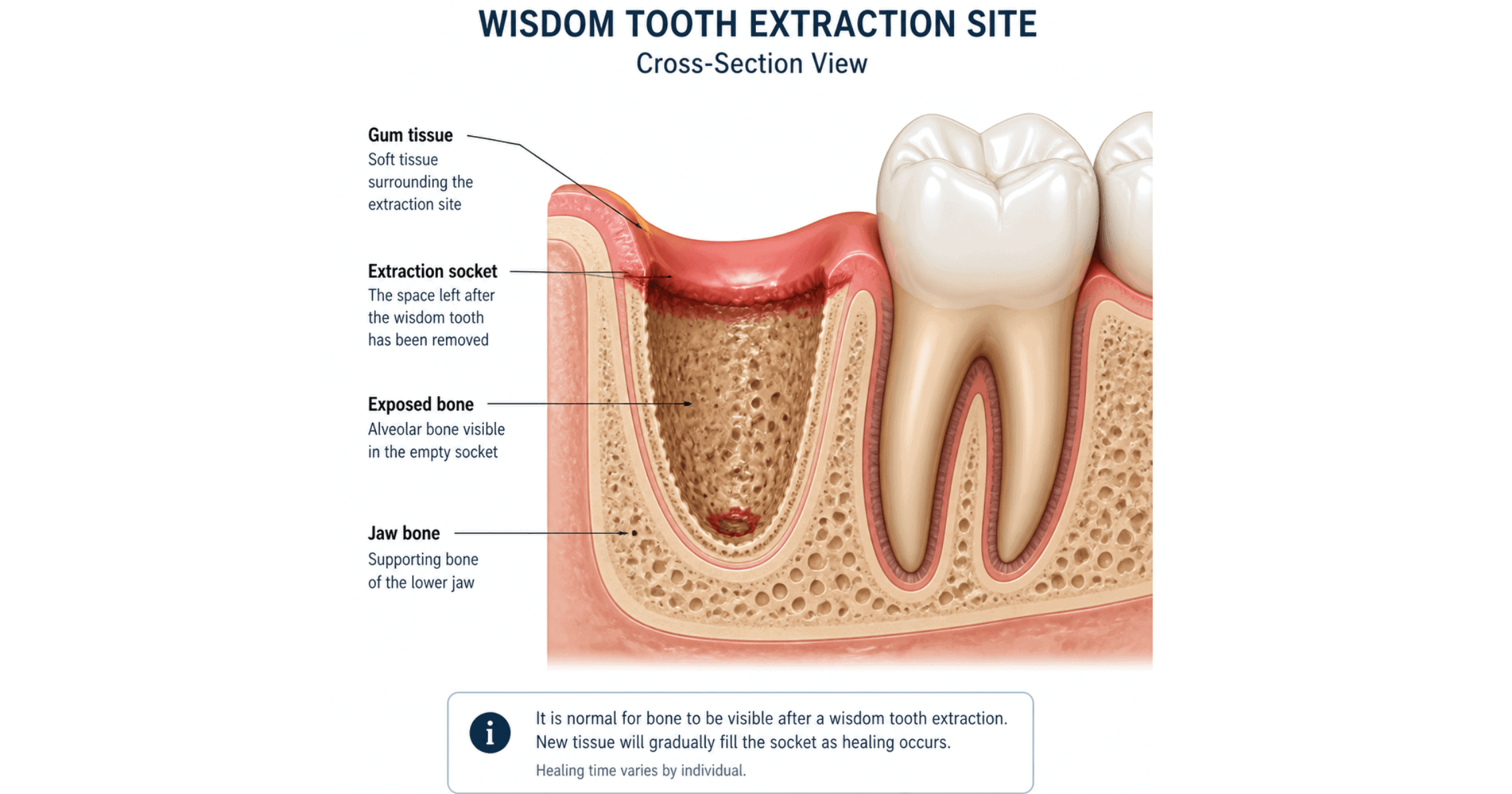 Diagram showing dry socket after wisdom tooth extraction with exposed bone in the empty socket in Cardiff
