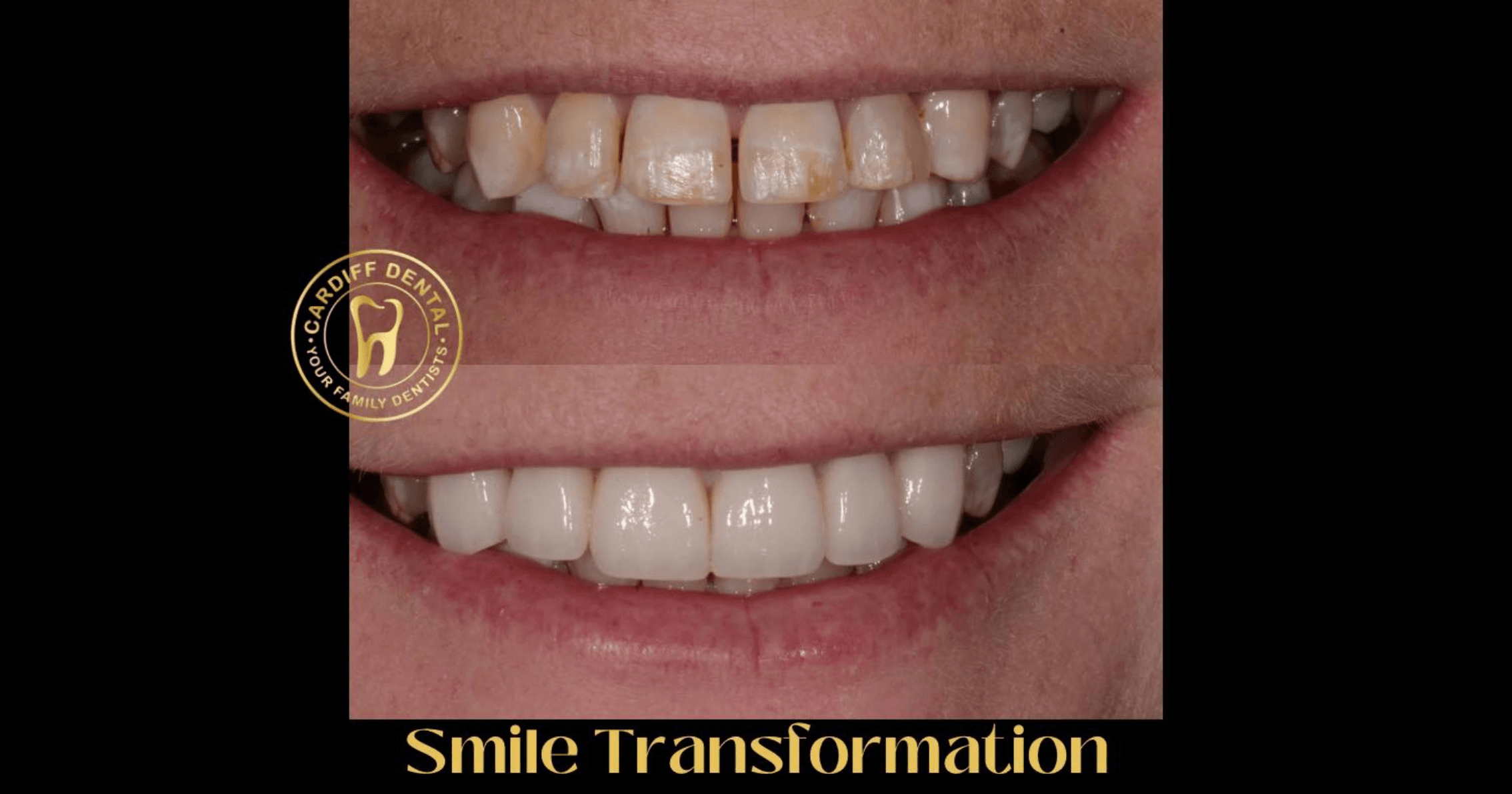 Before and after cosmetic dental treatment showing an improved smile at Cardiff Dental Newcastle