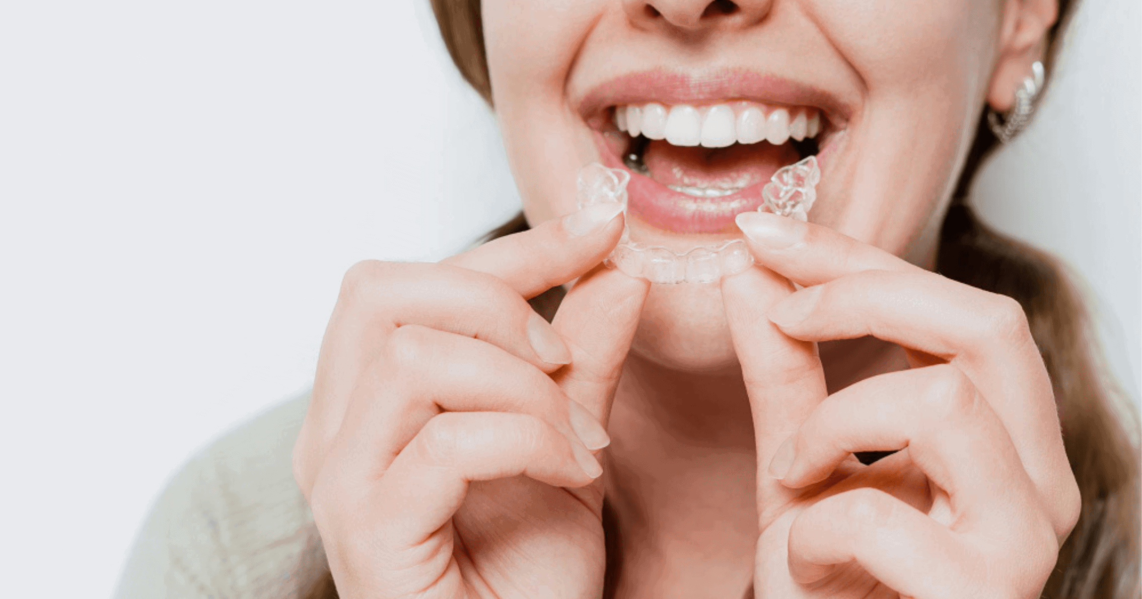 Invisalign in Newcastle_ Clear Aligners Explained