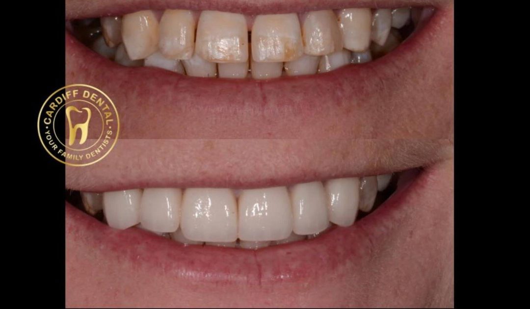 Why Do Teeth Turn Yellow — and Can You Reverse It?