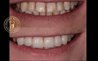 Why Do Teeth Turn Yellow — and Can You Reverse It?
