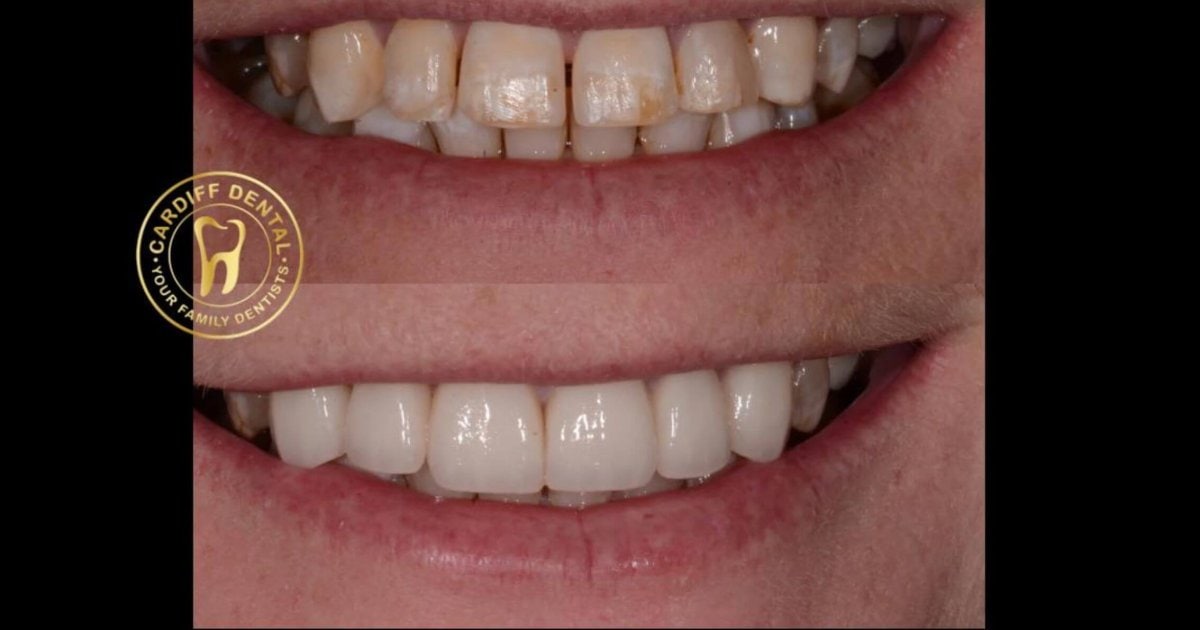 Close-up comparison of yellow stained teeth and whitened teeth in Cardiff