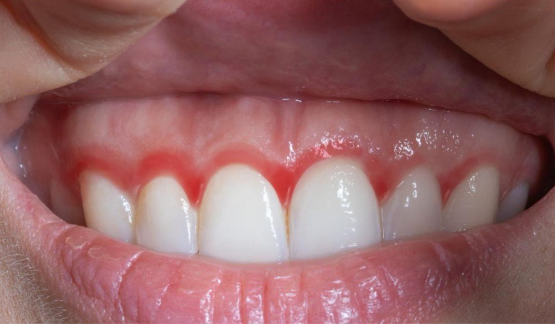 Swollen Gums: What Localised vs Widespread Swelling Means