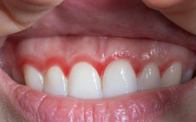 Swollen Gums: What Localised vs Widespread Swelling Means