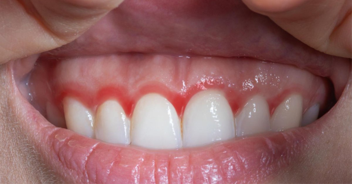Close-up of swollen, inflamed gum tissue around a tooth in Cardiff