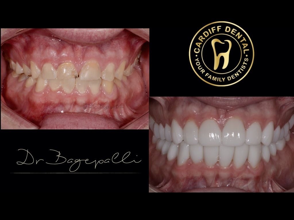 Smile Transformation Cardiff Dental