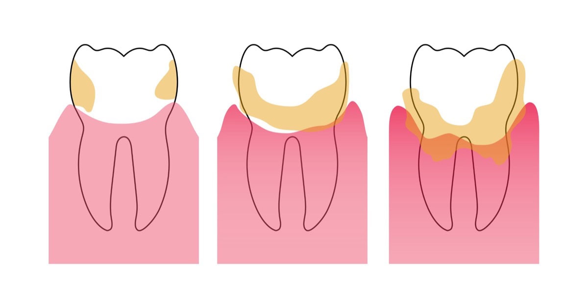 Diagram of plaque and tartar on a tooth at the gumline in Cardiff