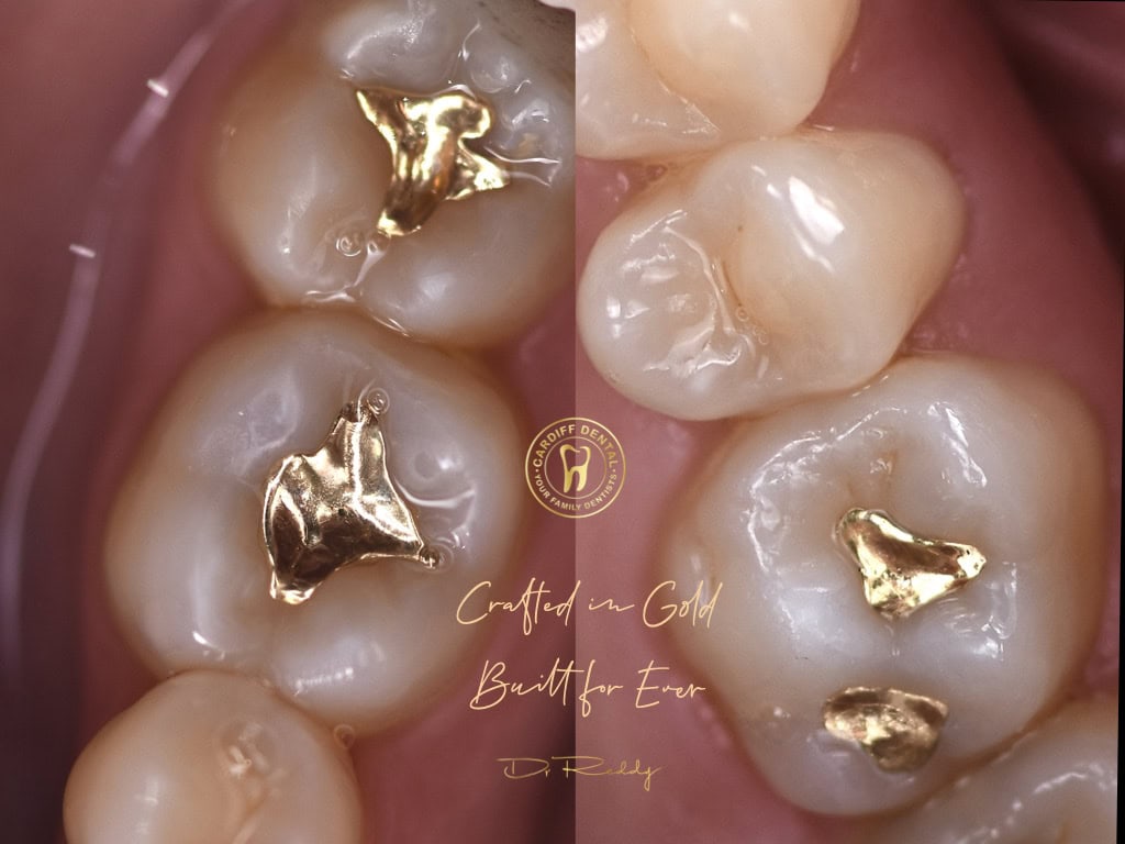 Gold inlays fitted to molars at Cardiff Dental