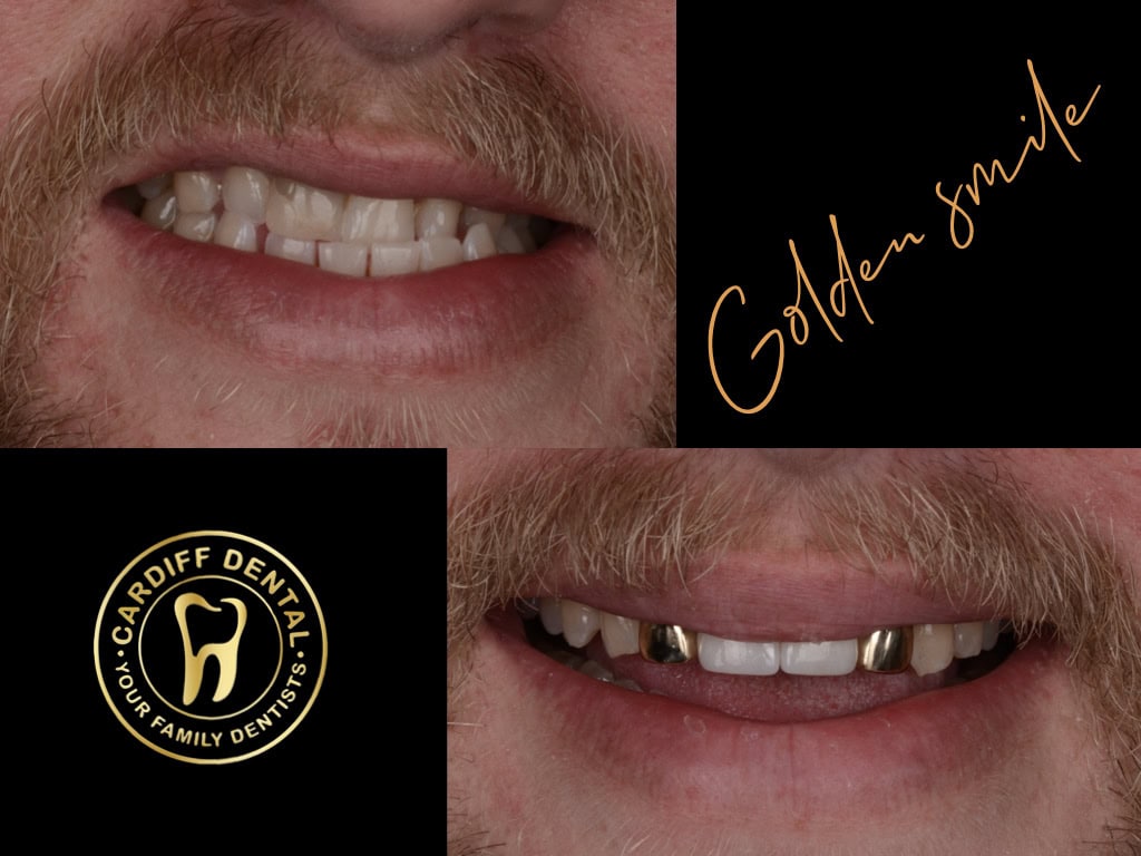 Gold crowns on a patient’s upper teeth at Cardiff Dental